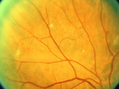 Retinopatia diabetica non proliferativa lieve