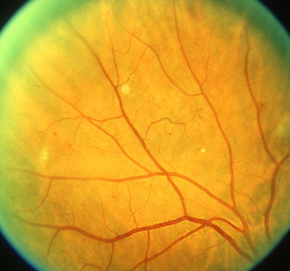 Retinopatia diabetica non proliferativa lieve