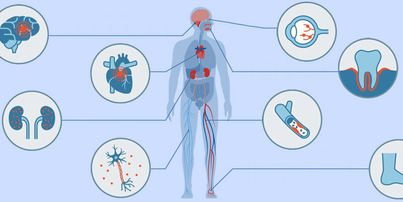 L’ATTIVITA’ FISICA: COMPONENTE FONDAMENTALE NELLA PREVENZIONE DELLE COMPLICANZE DEL DIABETE